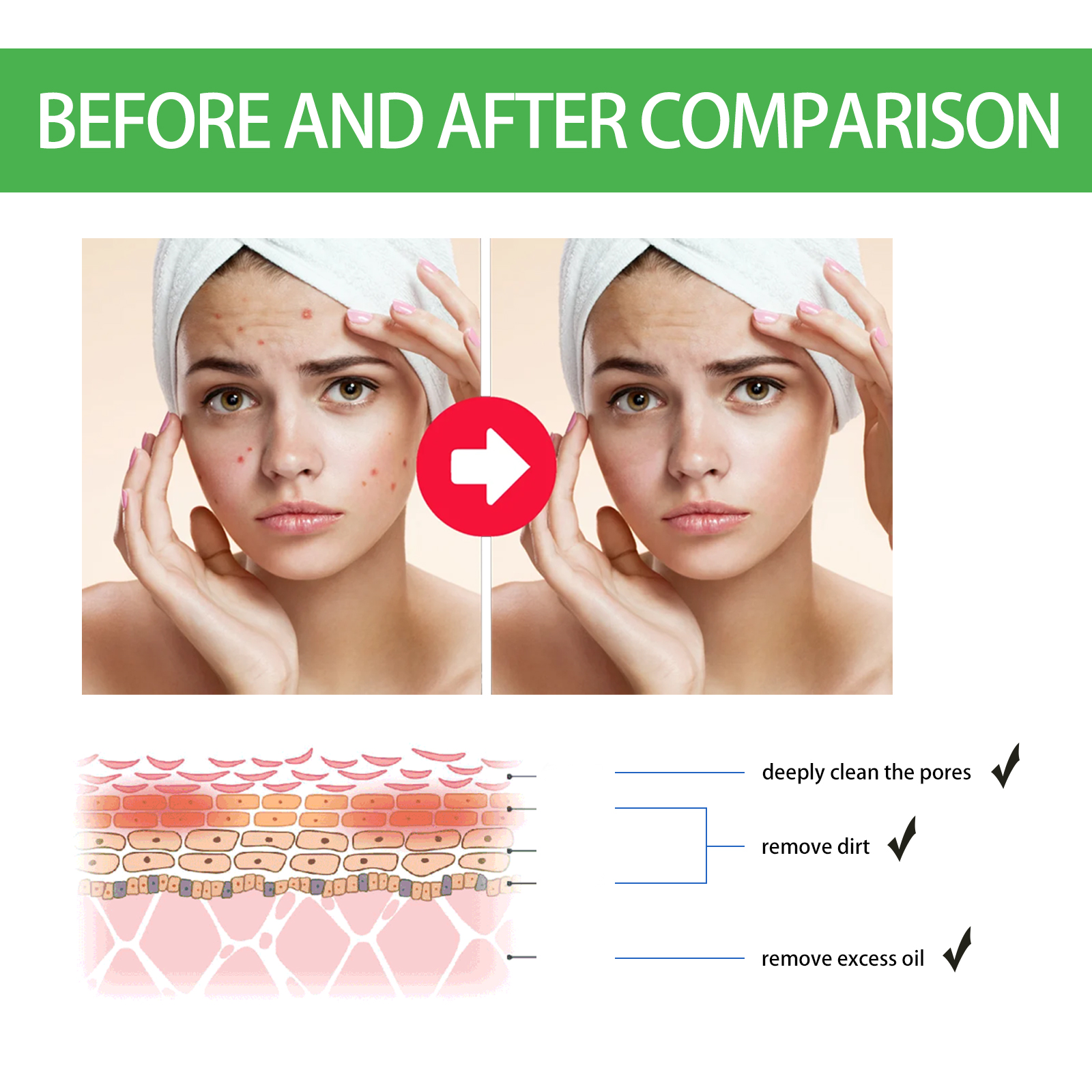 OUHOE Acne Patches for Face 20 - Tea Tree Spot Treatment avis et prix