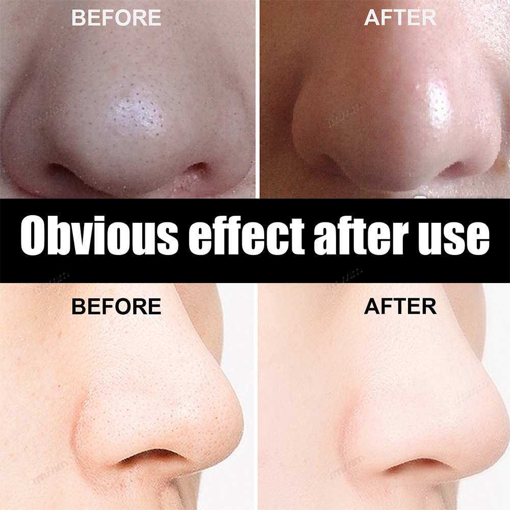New 10-100pcs Unisex Blackhead - Charcoal Pore Strip avis et prix