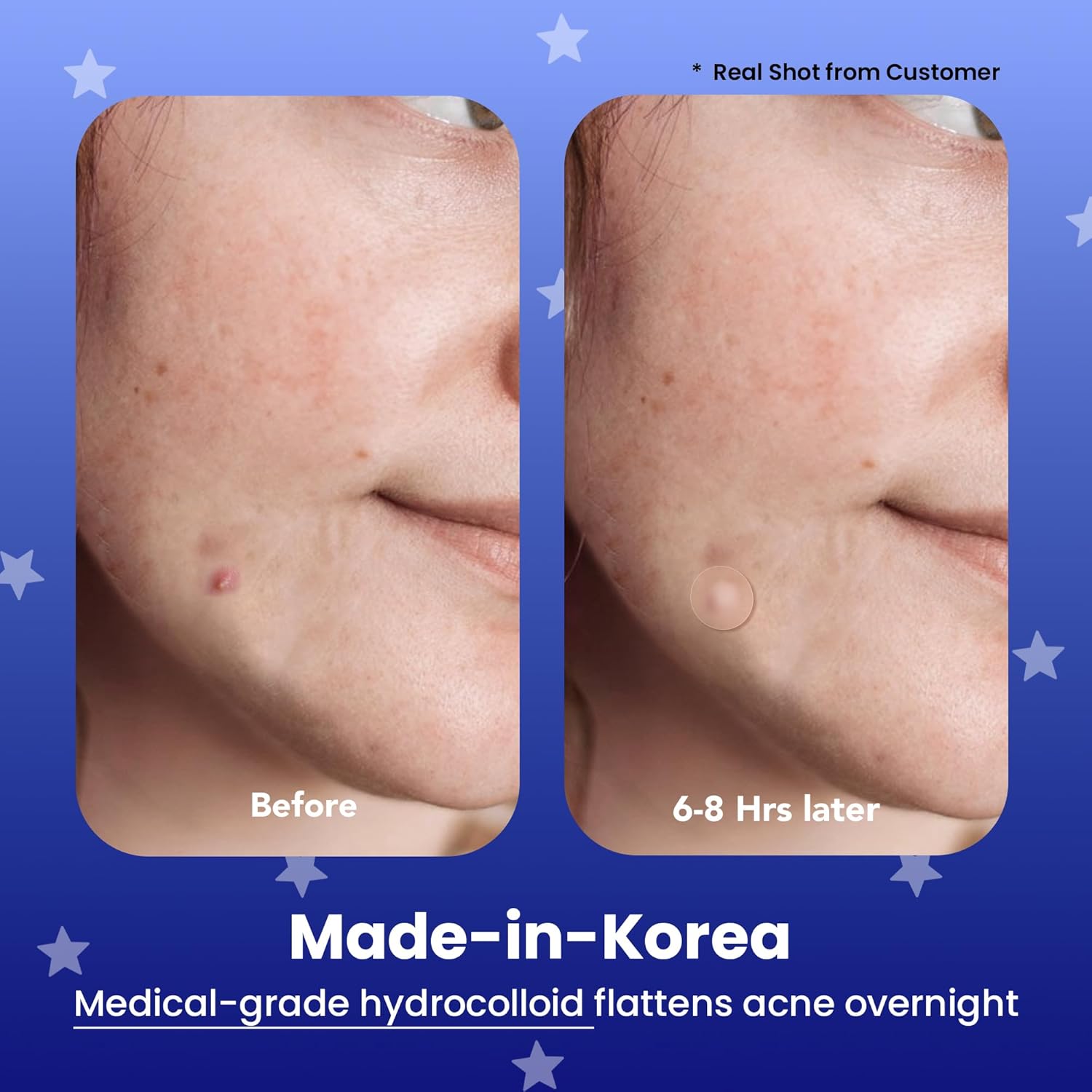 Acne Patch with Tea Tree Oil | - Tea Tree Spot Treatment avis et prix