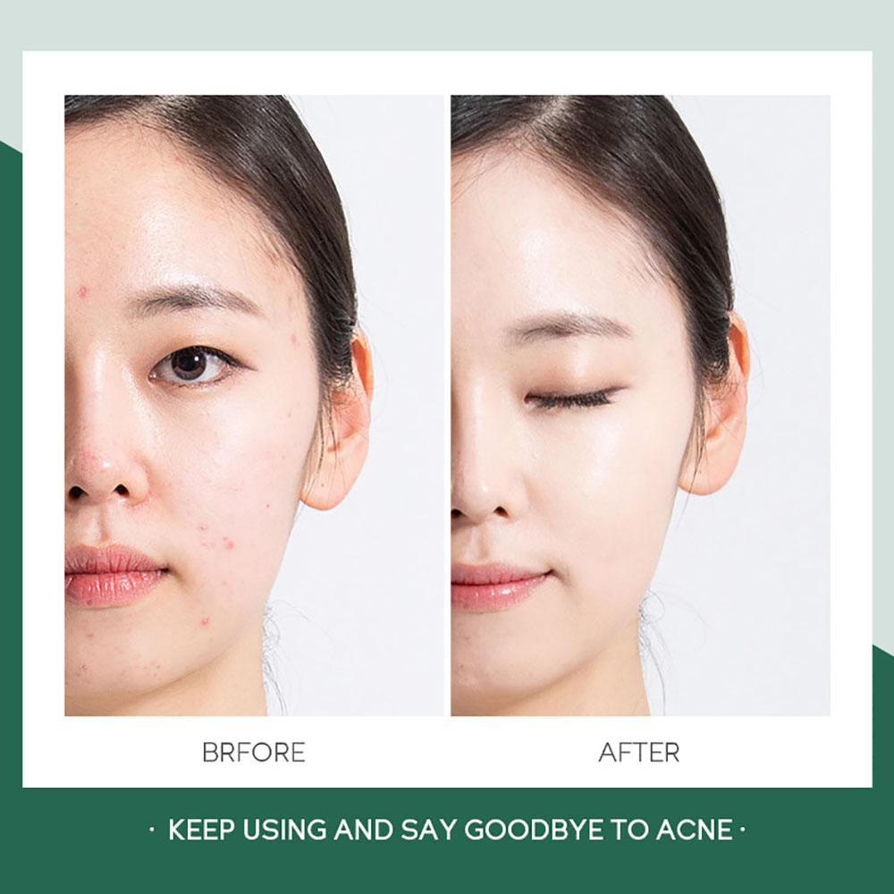 FENYI 20g Tea Tree Oil Acne Ge - Tea Tree Spot Treatment avis et prix